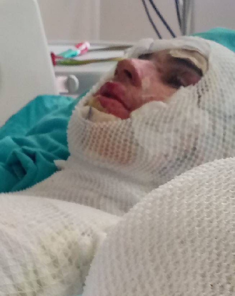 Adana’da Amca, 16 Yaşındaki Yeğenini Yanıcı Maddeyle Yaktı (3)