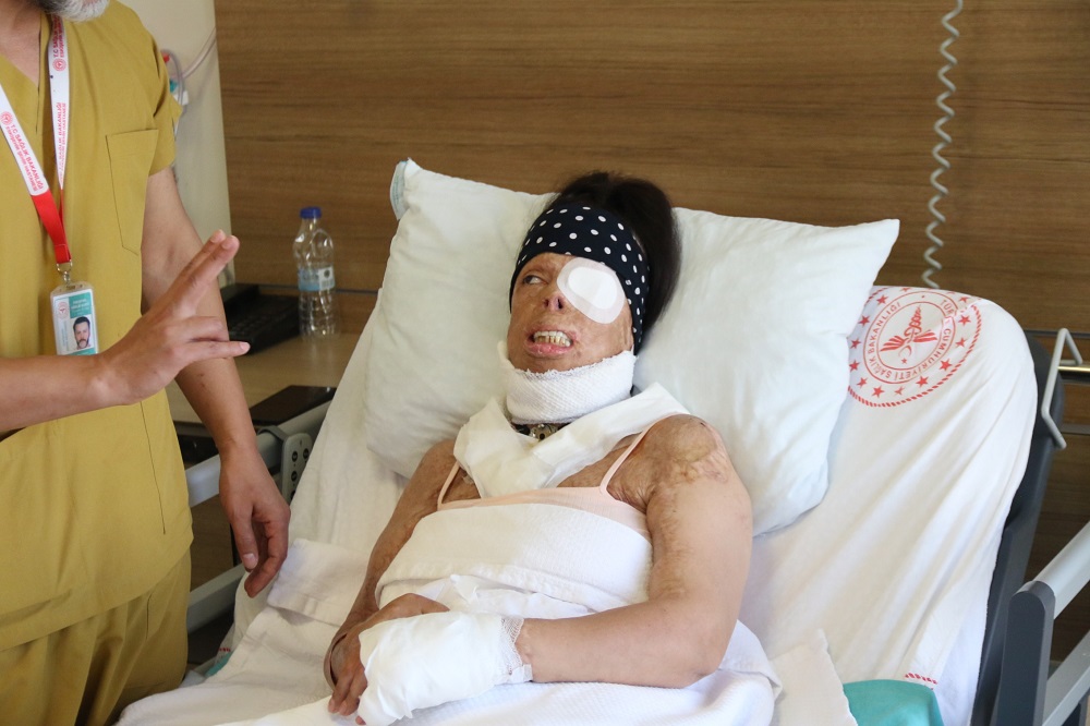 Yasemin’in Dramı Eski Sevgilisinin Kezzap Saldırısıyla Hayatı Karardı (1)