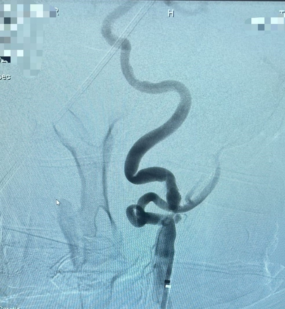 Kastamonu’da Şah Damarına Stent Tedavisi Başladı Felç Riski Azalıyor (2)