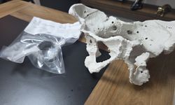 Zonguldak’ta 60 Yaşındaki Kadına 3D Yazıcıyla Kişiye Özel Kalça Protezi Takıldı
