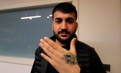 Dövme Sildirmek İsterken Kâbusu Yaşadı: Elinde İkinci Derece Yanık Oluştu