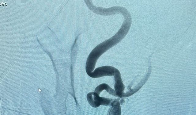 Kastamonu’da Şah Damarına Stent Tedavisi Başladı: Felç Riski Azalıyor